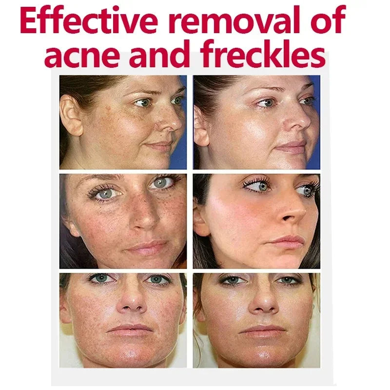 Niacinamide Brightening Melasma Cream